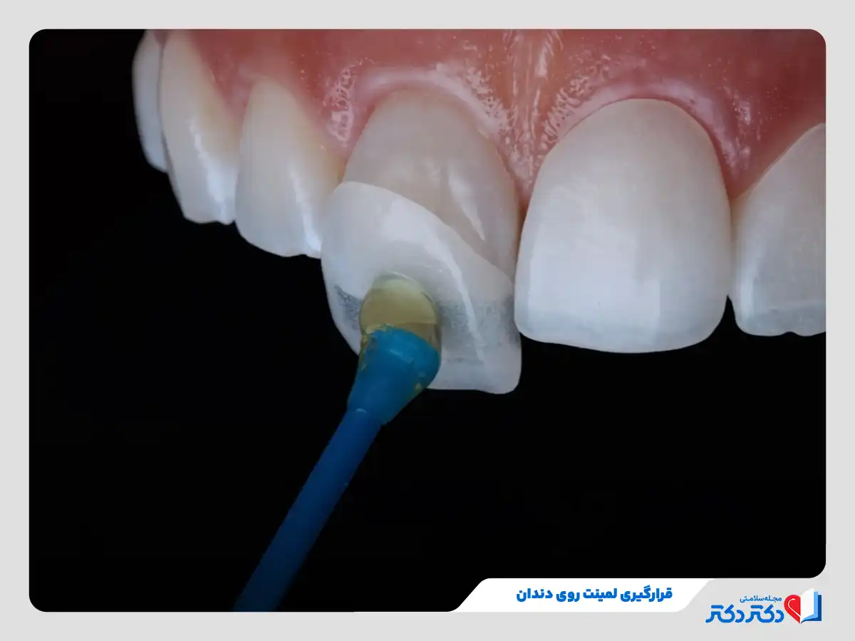 لمینت دندان چیست و انواع آن برای چه افرادی مناسب است؟_رنگو 20 قرارگیری روکش لمینت روی سطح دندان