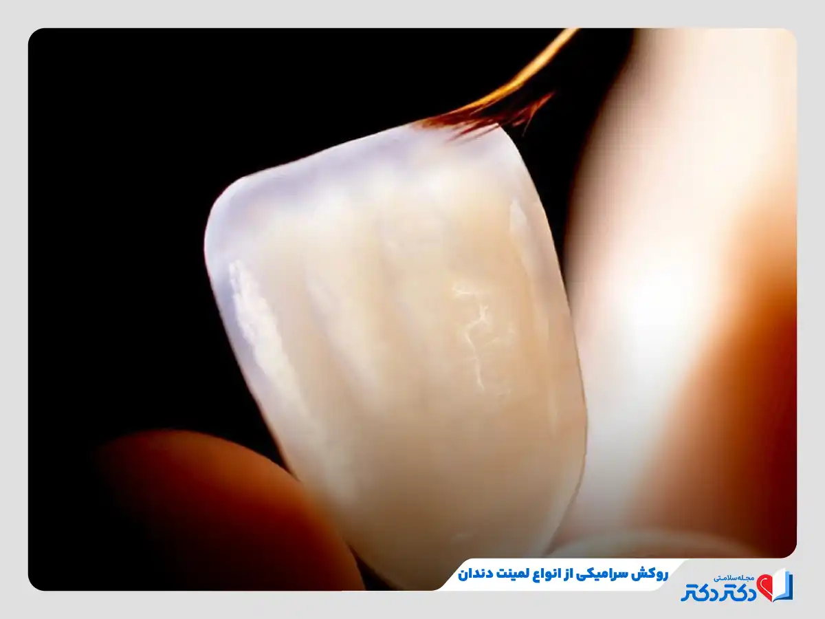 لمینت دندان چیست و انواع آن برای چه افرادی مناسب است؟_رنگو 18 لمینت سرامیکی