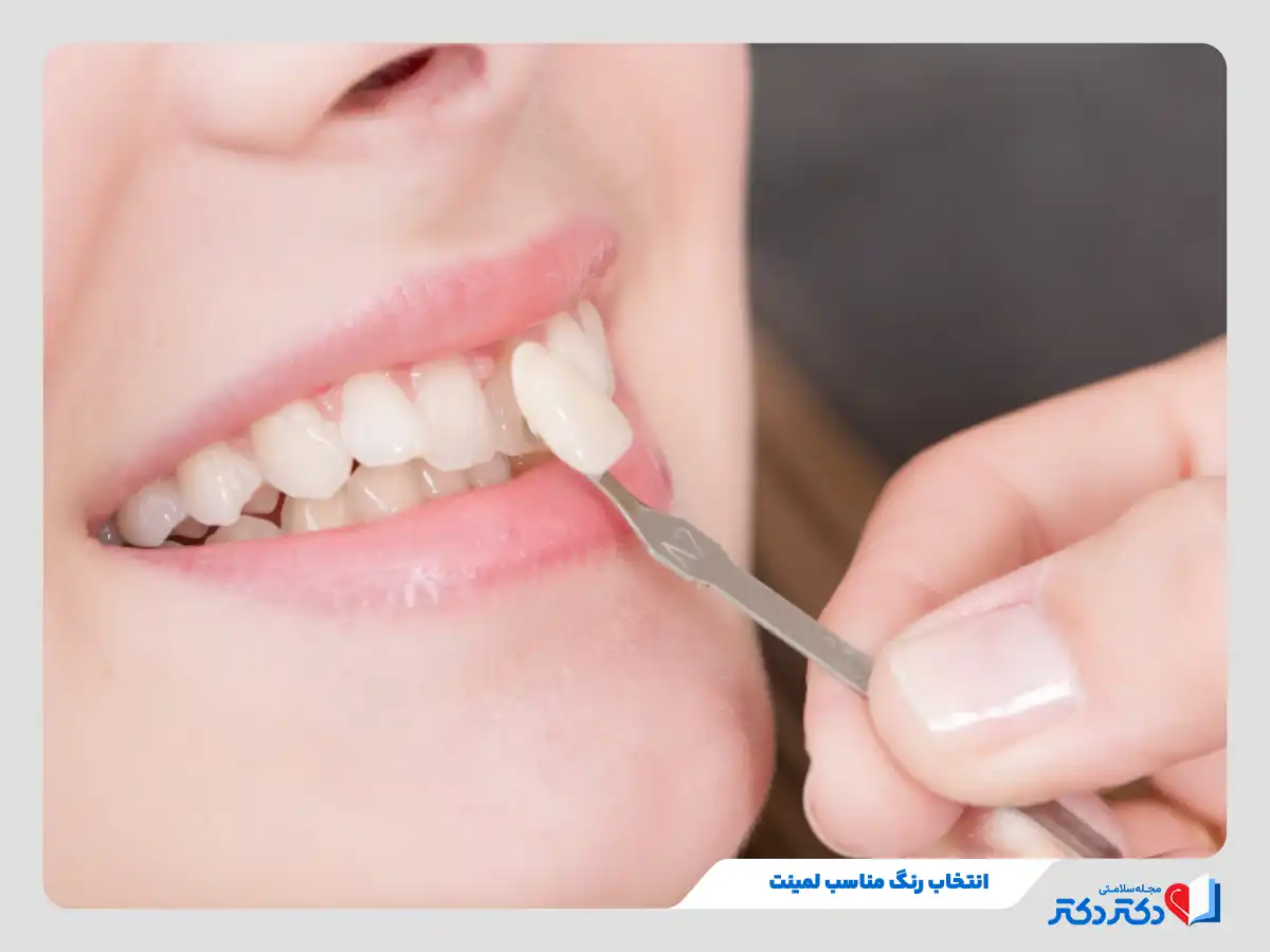 لمینت دندان چیست و انواع آن برای چه افرادی مناسب است؟_رنگو 22 انتخاب رنگ مناسب لمینت دندان