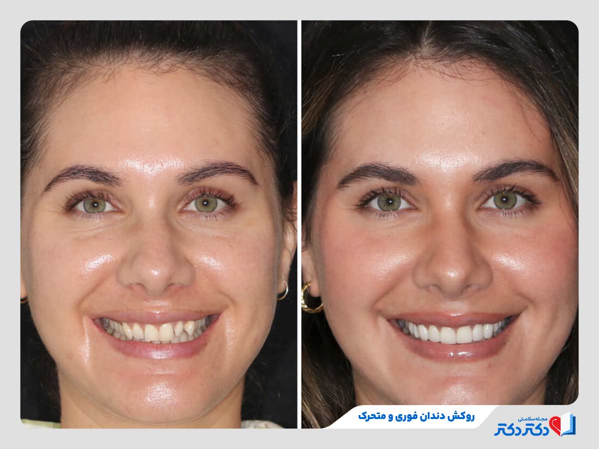 لمینت سرامیکی از انواع روکش دندان