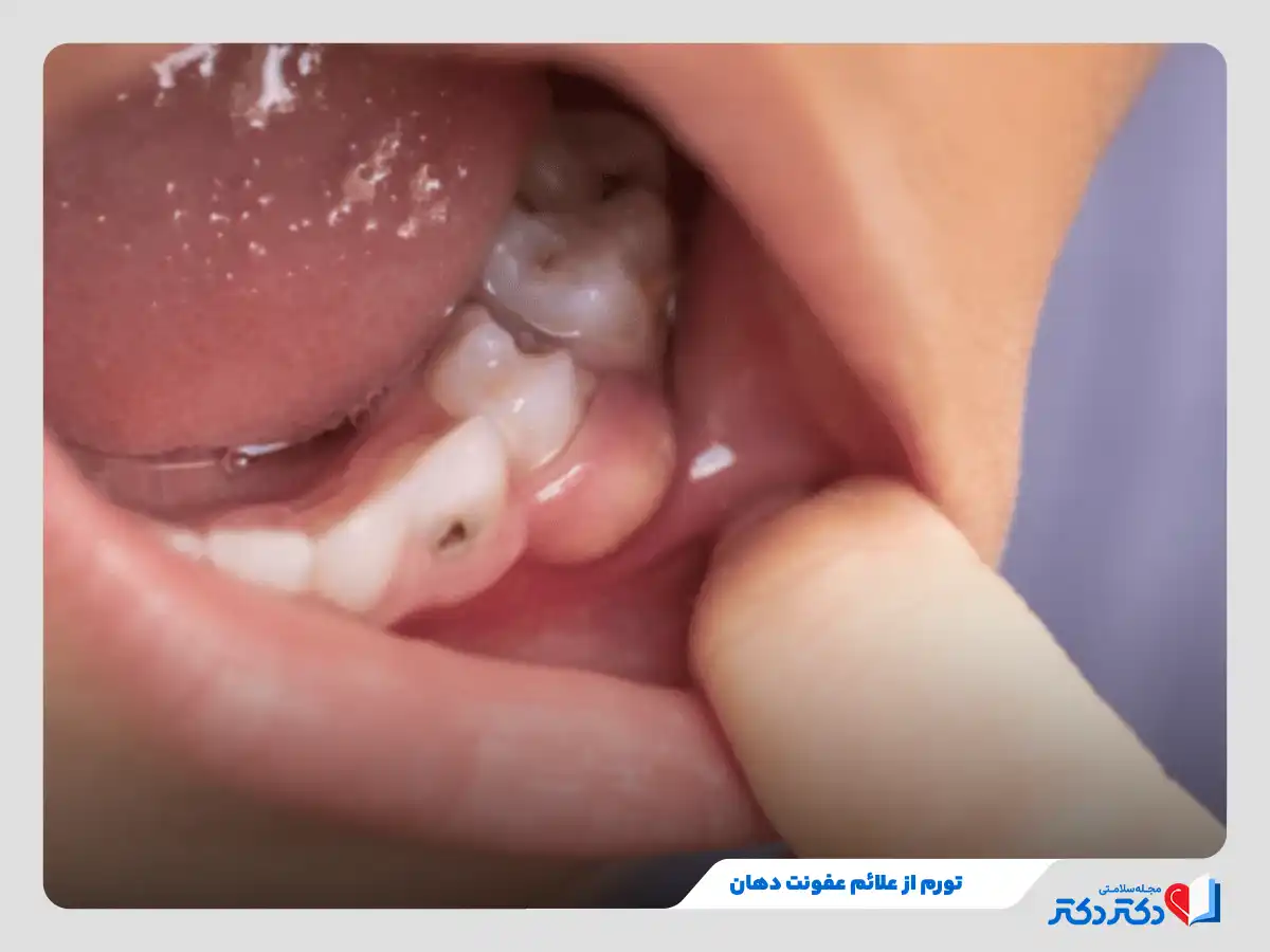 عفونت دهان چرا رخ میدهد؟ + علائم و درمانها_رنگو 4 تورم از علائم عفونت دهان