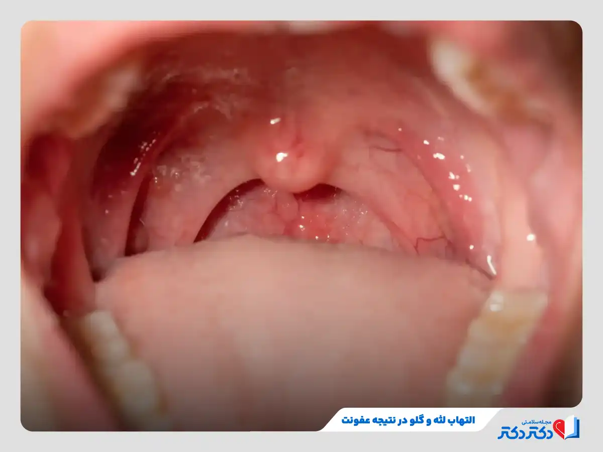 عفونت دهان چرا رخ میدهد؟ + علائم و درمانها_رنگو 8 التهاب و عفونت گلو و لثه