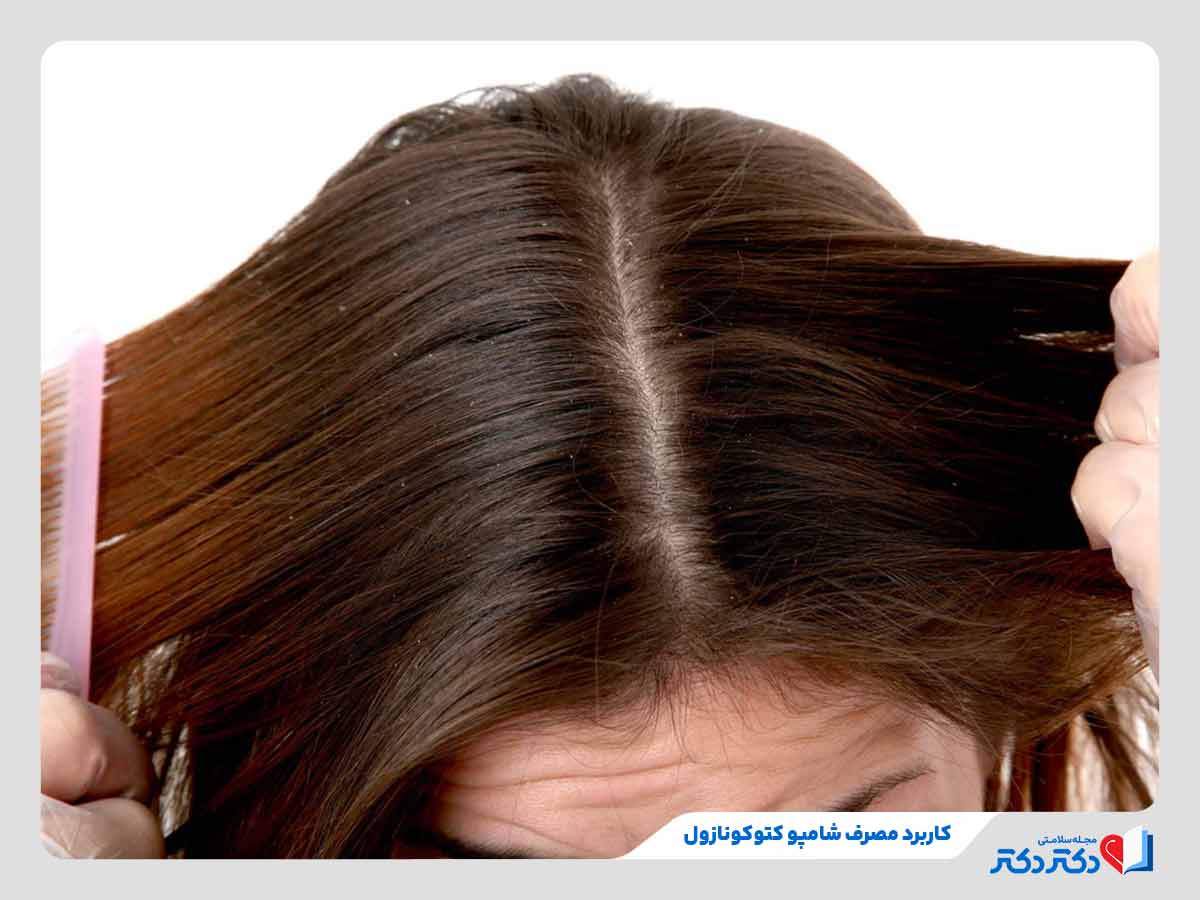 شامپو کتوکونازول چیست؟ بازدید انواع گوناگون این دارو + عوارض_رنگو 2 مکانیسم اثر شامپو کتوکونازول