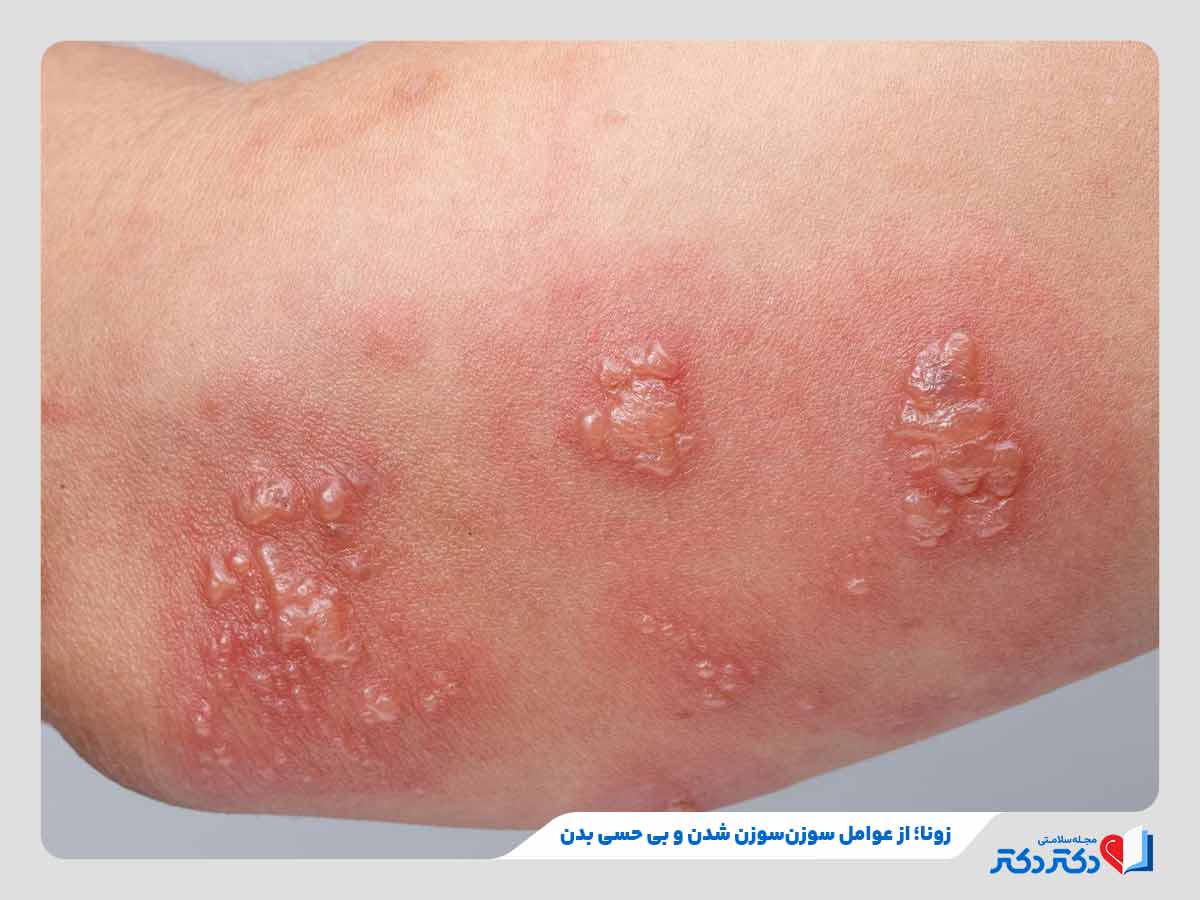 معارفه علل ابتلا به بی حسی بدن + بهترین راه حلهای درمان کرختی_رنگو 6 تجربه بی حسی بدن در اثر ابتلا به عفونتهایی مانند زونا