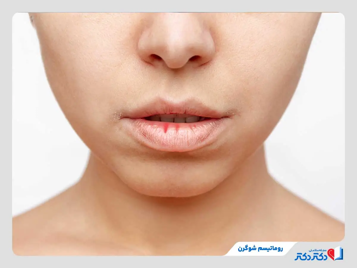 روماتیسم چیست و چه علائمی دارد ؟ + معارفه انواع روماتیسم_رنگو 6 خشکی چشم و دهان زن جوان بهدلیل روماتیسم شوگرن
