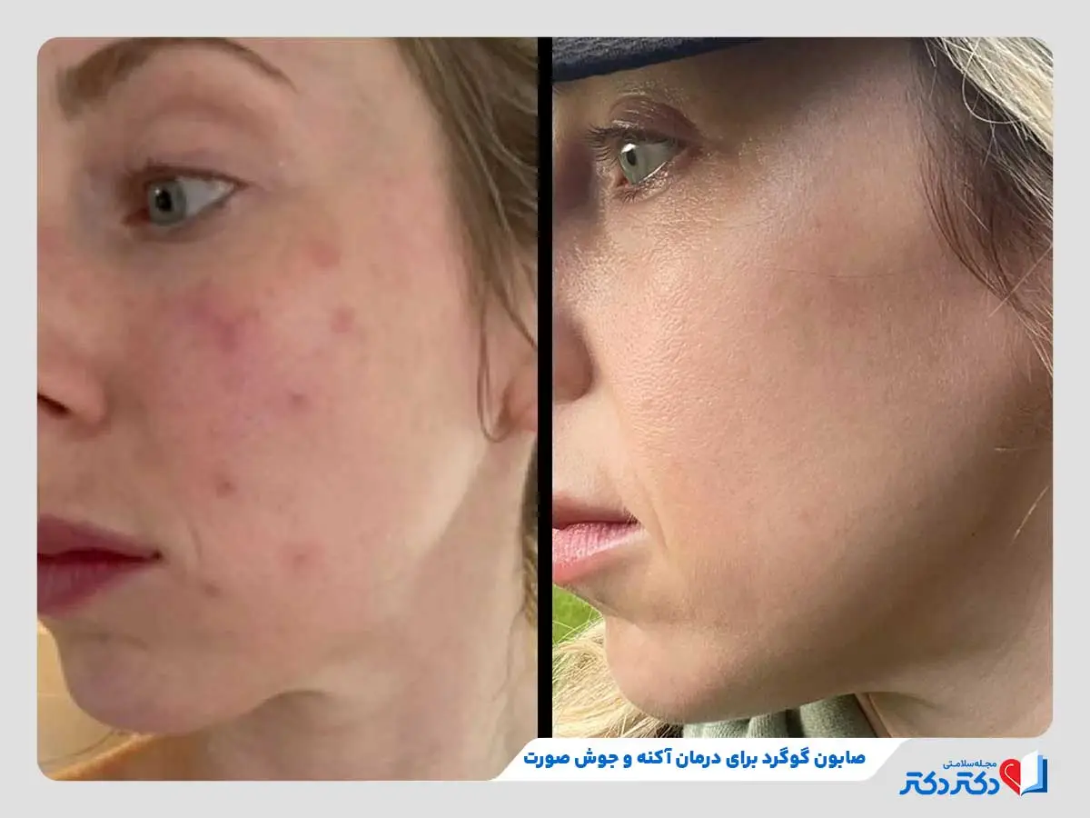 صابون گوگرد چیست و چه خواصی دارد؟ + بایدها و نبایدها_رنگو 26 قبل و بعد از استفاده از صابون گوگرد برای درمان جوش صورت