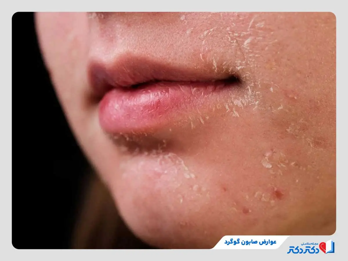 صابون گوگرد چیست و چه خواصی دارد؟ + بایدها و نبایدها_رنگو 34 خشکی و پوستهپوسته شدن پوست دختر جوان بعد از استفاده از صابون گوگرد