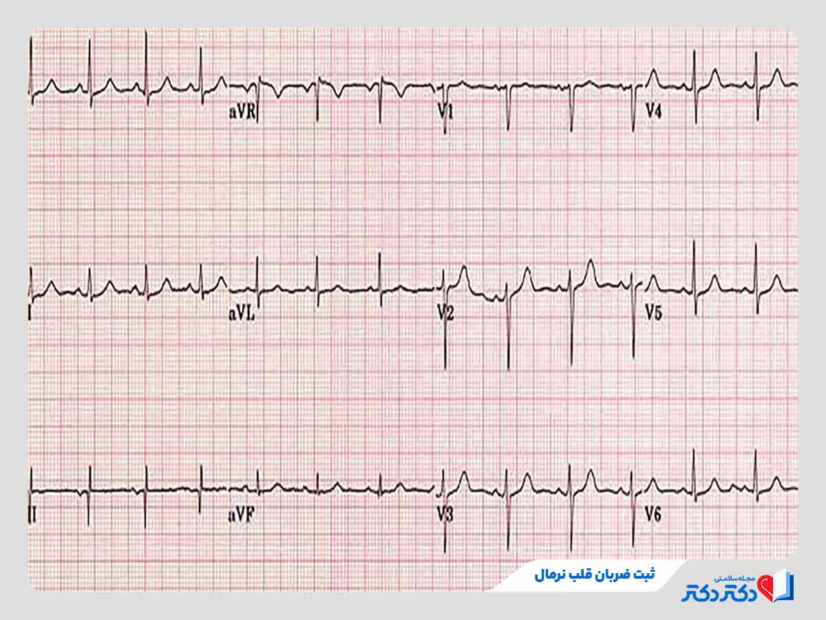 نوار قلب و تفسیر انواع آن + نحوه گرفتن تست الکتروکاردیوگرام_رنگو 36 نتیجه تست نوار قلب نشان دهنده ریتم نرمال و منظم ضربان قلب
