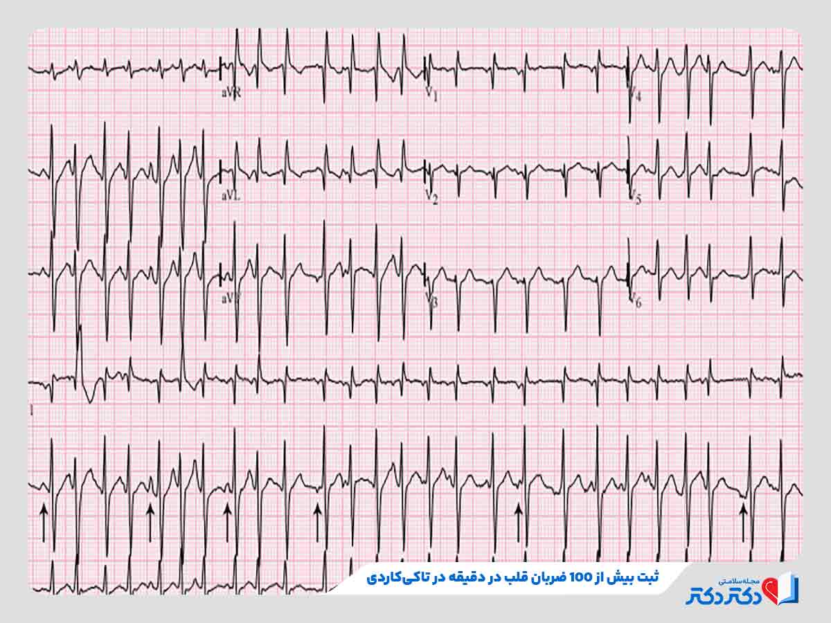 نوار قلب و تفسیر انواع آن + نحوه گرفتن تست الکتروکاردیوگرام_رنگو 38 نتیجه تست نوار قلب نشاندهنده ابتلای فرد به تاکیکاردی