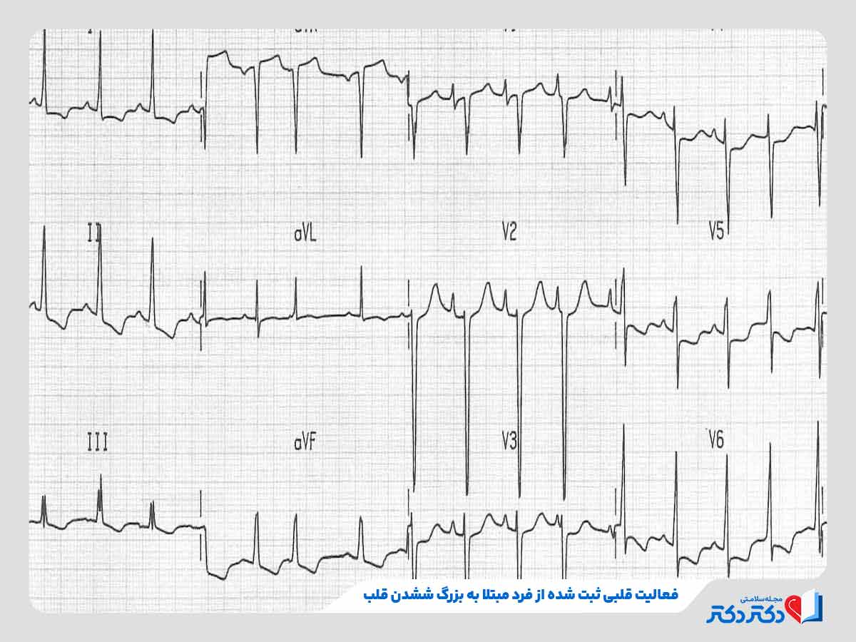 نوار قلب و تفسیر انواع آن + نحوه گرفتن تست الکتروکاردیوگرام_رنگو 42 نتیجه تست نوار قلب نشاندهنده ابتلای فرد به بزرگشدن حفرههای قلبی