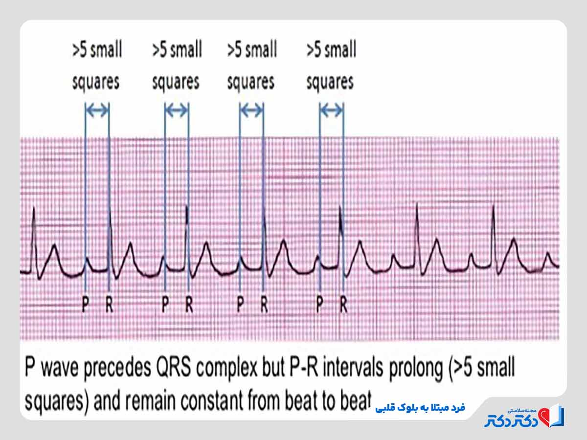 نوار قلب و تفسیر انواع آن + نحوه گرفتن تست الکتروکاردیوگرام_رنگو 40 نتیجه تست نوار قلب نشاندهنده ابتلای فرد به بلوک قلبی یکی از اختلالات هدایتی قلبی