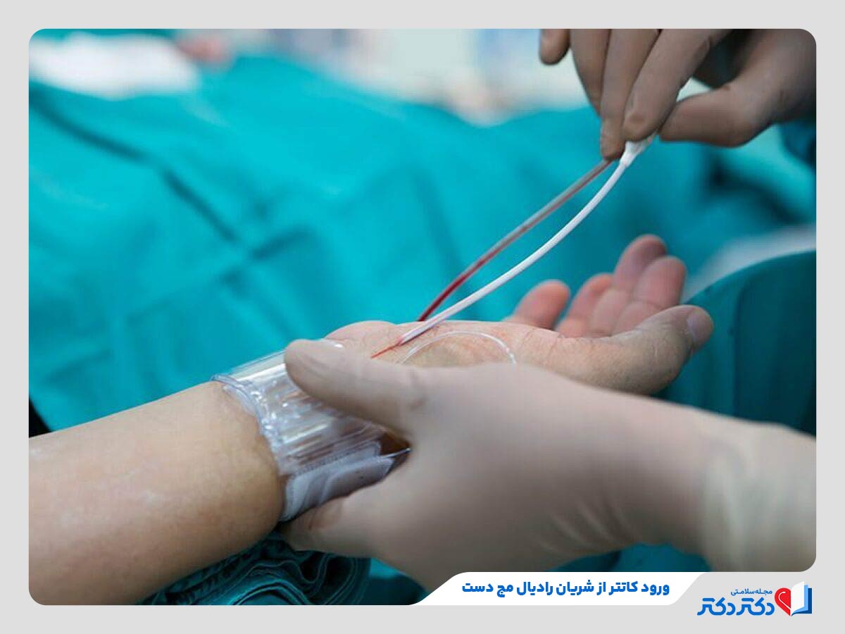 آنژیوگرافی قلب چیست؟ آیا نیاز به بیهوشی دارد؟ + تصاویر_رنگو 28 انجام آنژیوگرافی قلب از طریق شریان مچ دست