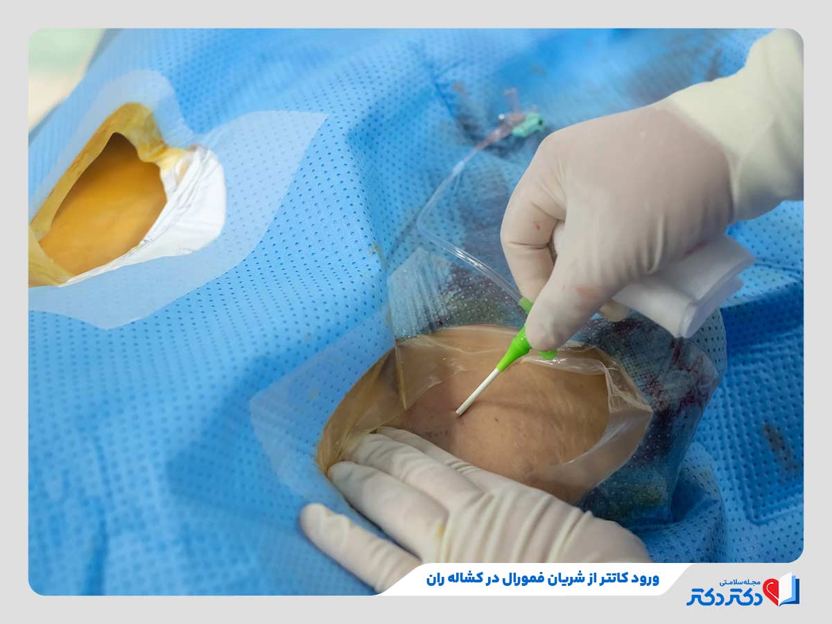 آنژیوگرافی قلب چیست؟ آیا نیاز به بیهوشی دارد؟ + تصاویر_رنگو 26 ورود کاتتر از شریان فریال یکی از مراحل انجام آنژیوگرافی قلب