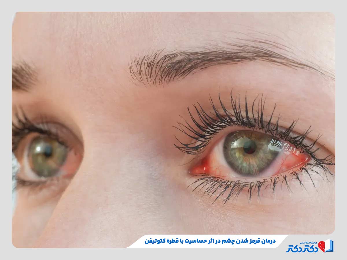 همه چیز درمورد داروی کتوتیفن و موارد مصرف آن_رنگو 28 فرد مبتلا به قرمزی چشم در اثر حساسیت فصلی و نیازمند به مصرف داروی کتوتیفن