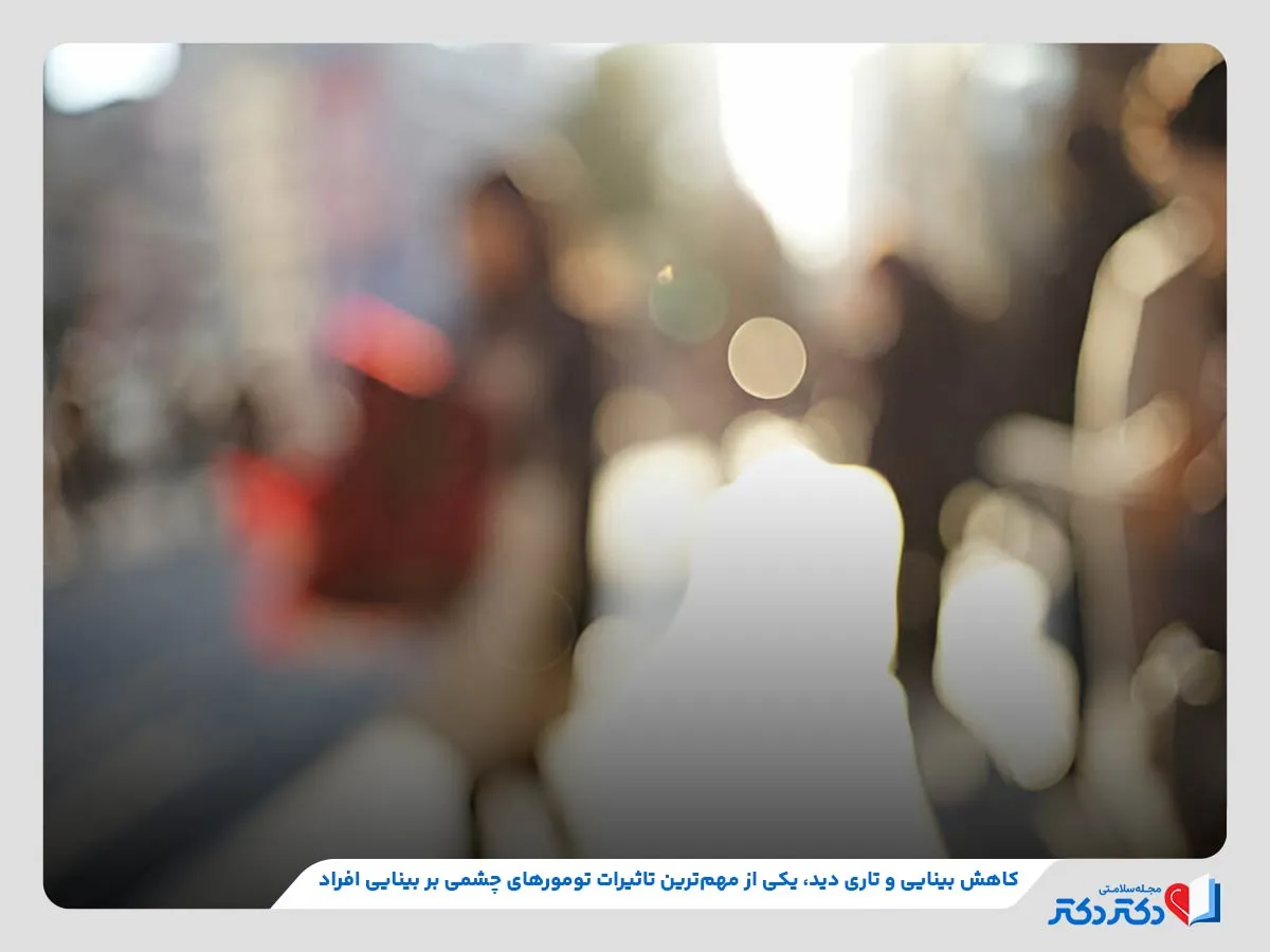 انواع تومور چشمی + بازدید راه حلهای درمانی موثر_رنگو 2 تاری دید و کاهش بینایی درنتیجه ابتلا به تومور چشمی