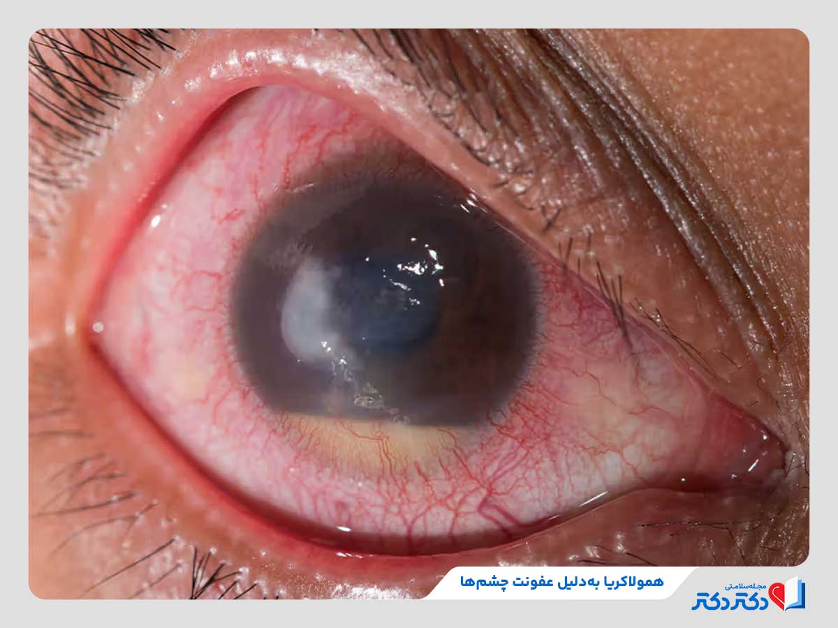 12 علتی که علتبیماری همولاکریا چشم خواهد شد! + درمان_رنگو 20 عفونت چشم از دلایل بیماری همولاکریا