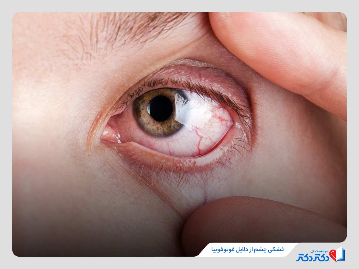 حساسیت چشم به نور چیست؟ بازدید همه علل، علائم و درمانها_رنگو 4 خشکی چشم یکی از دلایل مهم حساسیت چشم به نور