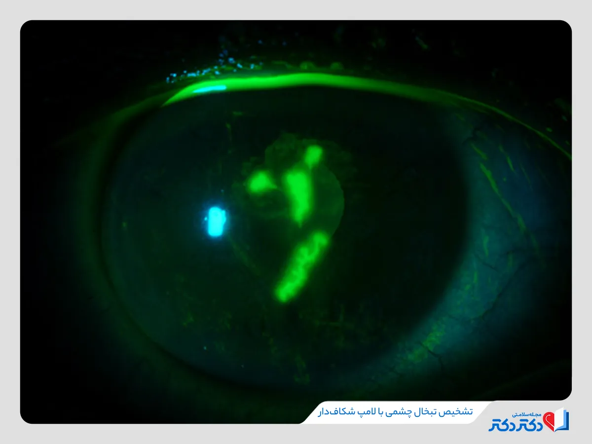 لامپ شکاف دار یکی از روشهای بالینی برای تشخیص تبخال چشمی