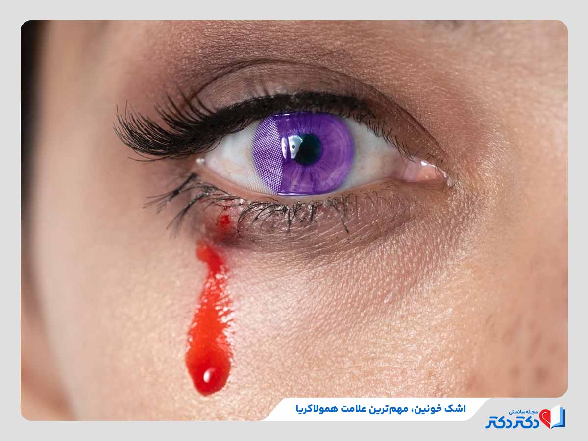 12 علتی که علتبیماری همولاکریا چشم خواهد شد! + درمان_رنگو 24 اشک خونین مهمترین علامت بیماری همولاکریا