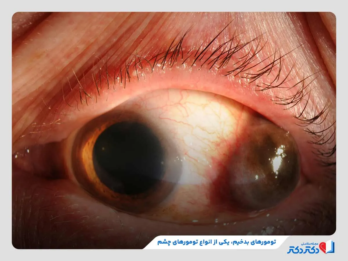 انواع تومور چشمی + بازدید راه حلهای درمانی موثر_رنگو 6 تومورهای بدخیم چشمی، یکی از انواع تومور چشم