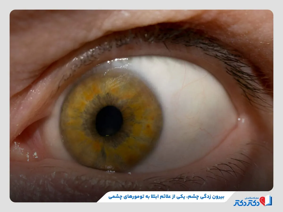 انواع تومور چشمی + بازدید راه حلهای درمانی موثر_رنگو 4 بیرونزدگی چشم یا خروج چشم از حدقه، از علائم ابتلا به تومورهای چشمی