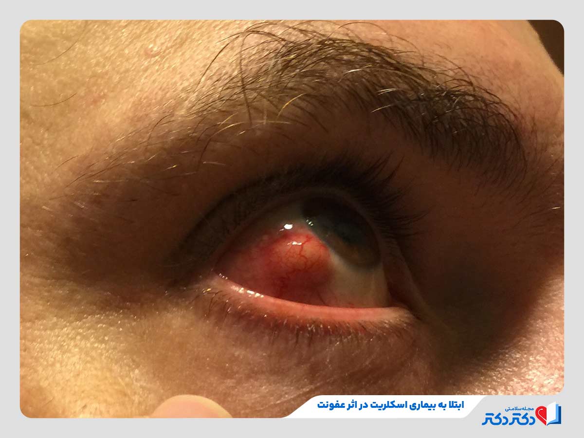 بیماری اسکلریت چشم چیست و چطور درمان میبشود؟_رنگو 6 ابتلای فرد به بیماری اسکلریت در اثر عفونت چشم