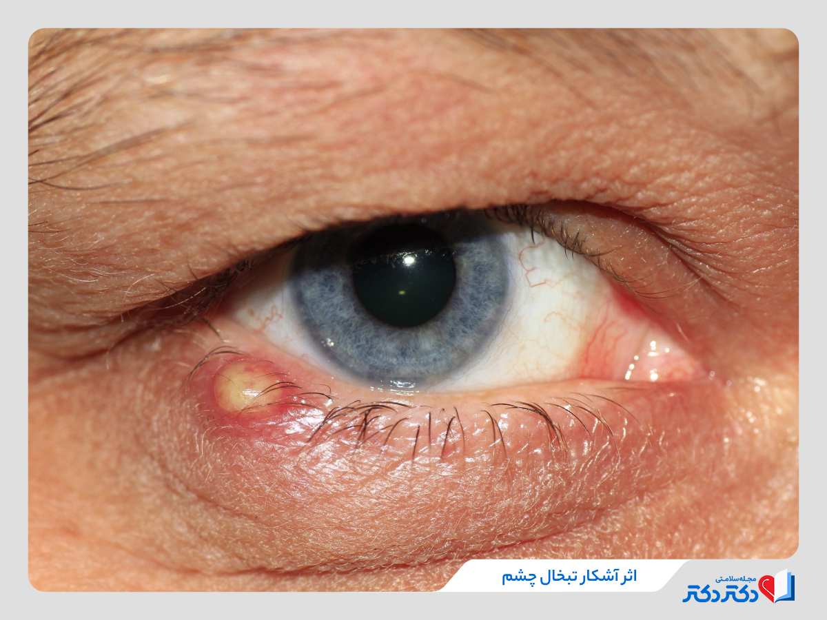 یکی از انواع تبخال چشمی در یک مرد میانسال