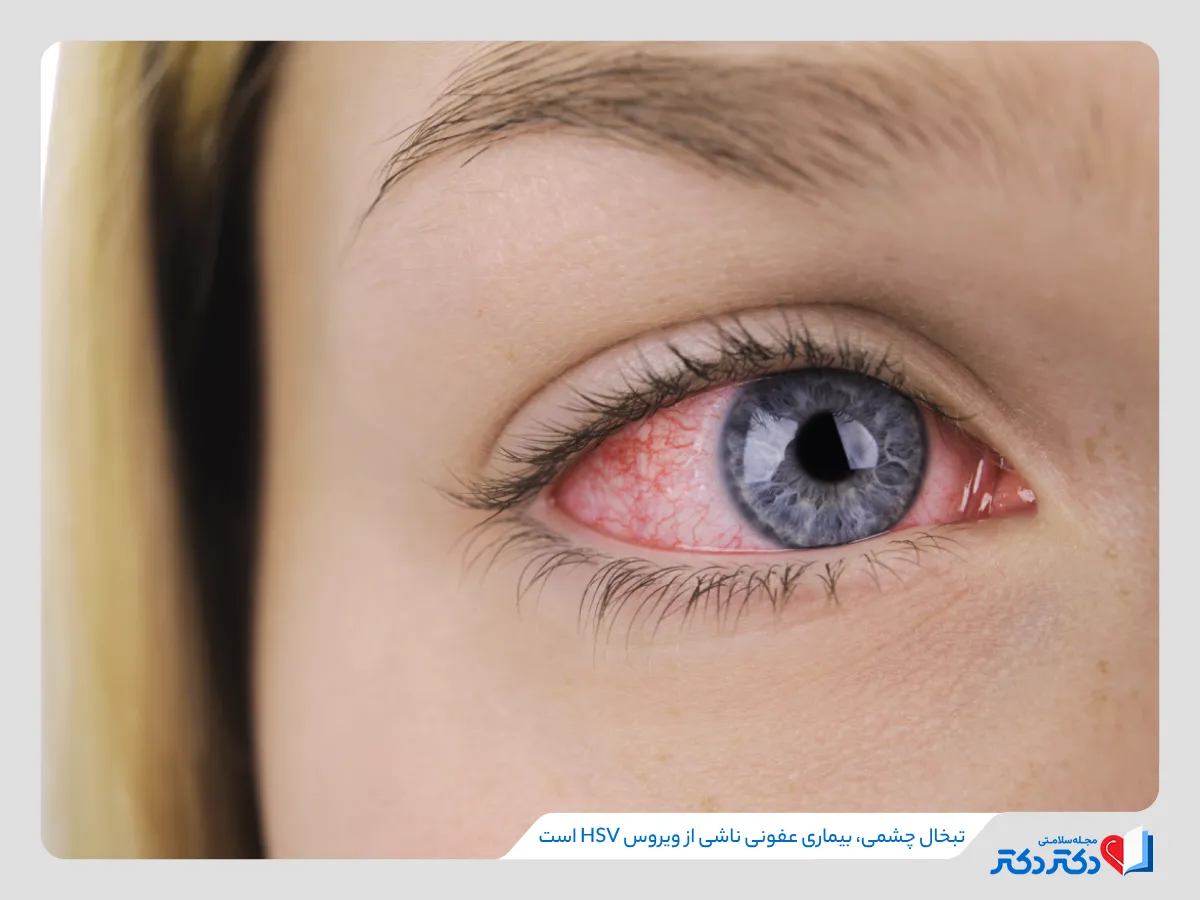 تبخال چشمی یک بیماری عفونی ناشی از ویروس چشمی است