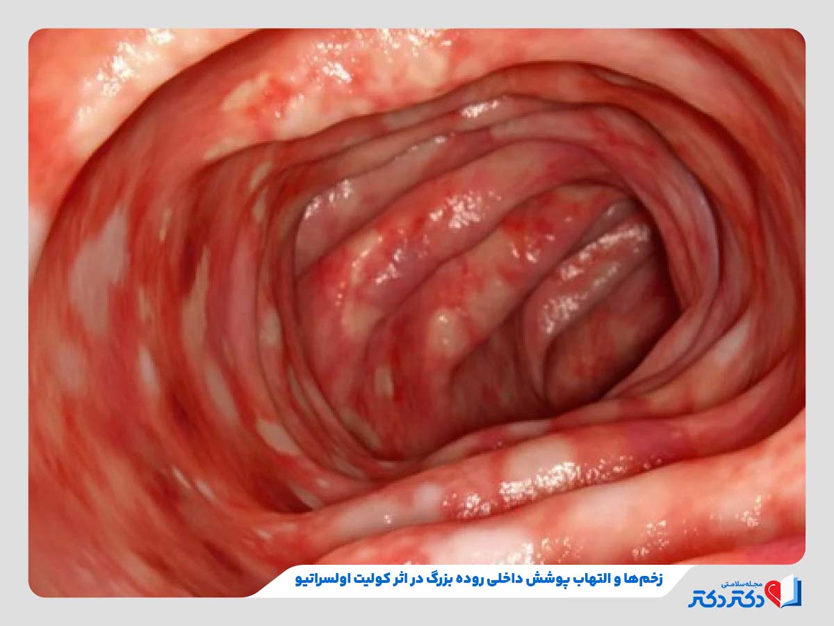 کولیت اولسراتیو چیست؟ + علائم کولیت روده، درمان و کنترل_رنگو 2 ابتلای فرد به کولیت اولسراتیو و ظهور التهاب و زخم در دیواره روده بزرگ