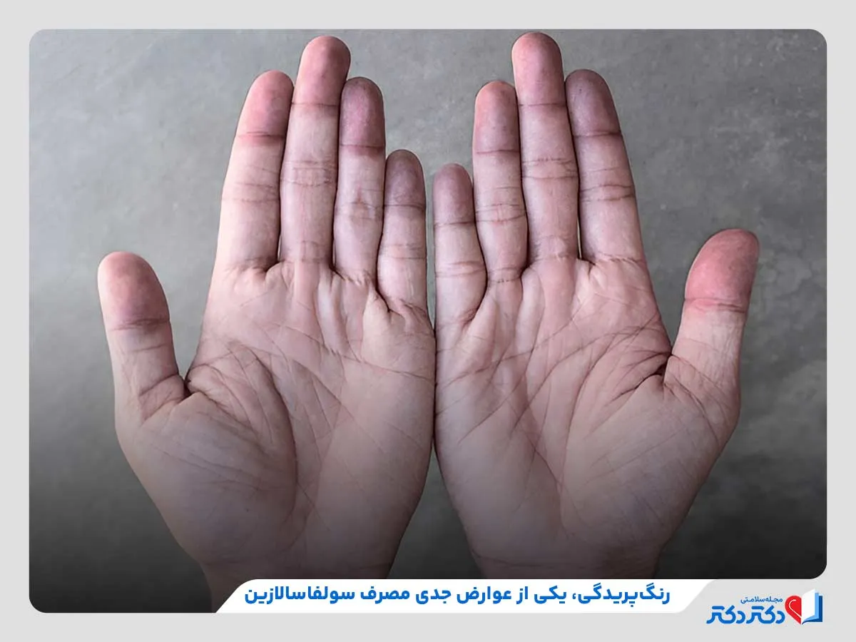 سولفاسالازین چیست؟ بازدید کاربر و عوارض_رنگو 24 رنگپریدگی پوست، از عوارض جدی مصرف سالازوپیرین