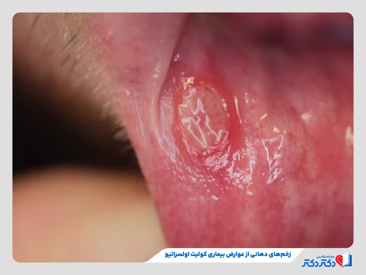 فرد مبتلا به زخم دهان در اثر ابتلا یه ابتلا به کولیت اولسراتیو