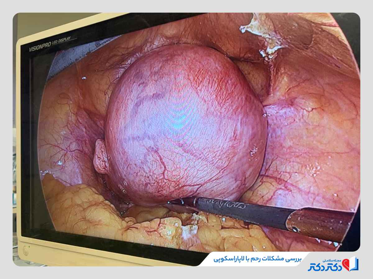 لاپاراسکوپی رحم چطور انجام میبشود؟ تایید شده توسط دکتر زنان_رنگو 4 تصویری واضح از فرآیند لاپاراسکوپی رحم