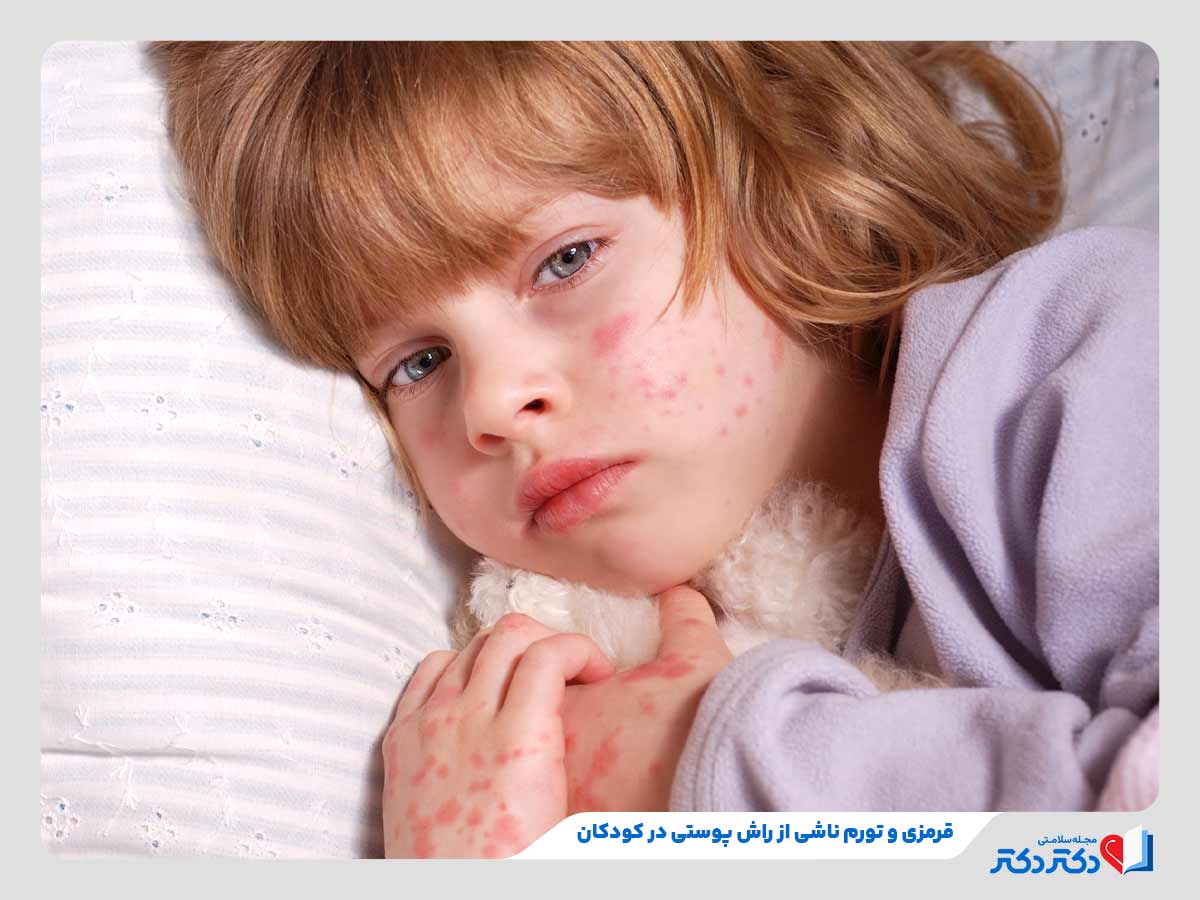 بثورات پوستی کودکان - بازدید دلایل، علائم، انواع و درمان_رنگو 24 ظهور خارش، قرمزی و تورم به دلیل راش پوستی در کودکان
