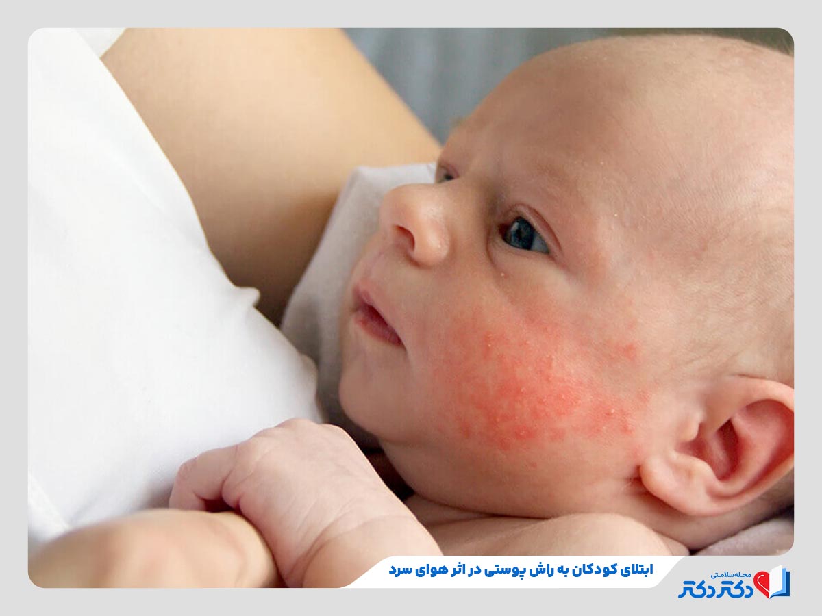 بثورات پوستی کودکان - بازدید دلایل، علائم، انواع و درمان_رنگو 22 سرما و خشکی هوا از عوامل اصلی ابتلا به راش پوستی در کودکان