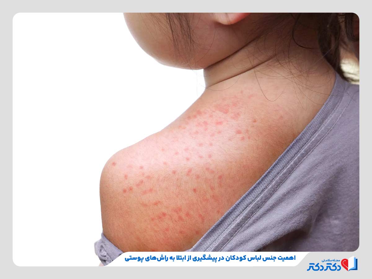 بثورات پوستی کودکان - بازدید دلایل، علائم، انواع و درمان_رنگو 28 کودک مبتلا به راش پوستی به دلیل پوشیدن لباس نامناسب