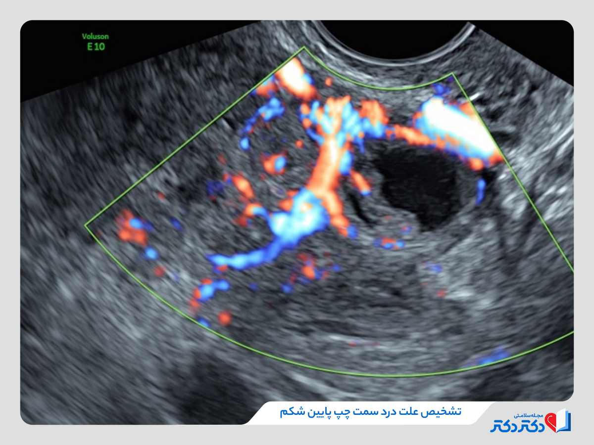 درد سمت چپ پایین شکم چه دلیلی دارد؟ + علائم و درمان_رنگو 26 تشخیص درد سمت چپ پایین شکم