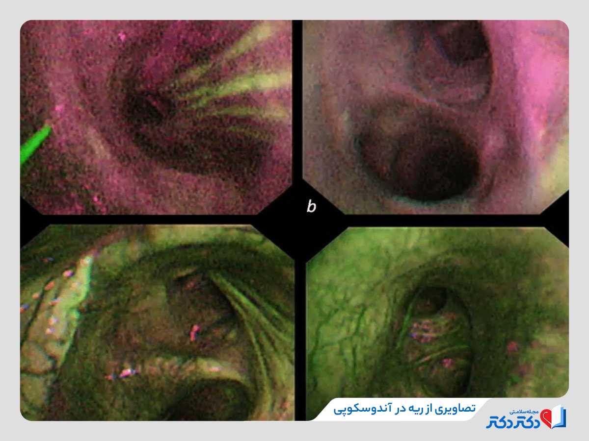 تصاویری از آندوسکوپی ریه