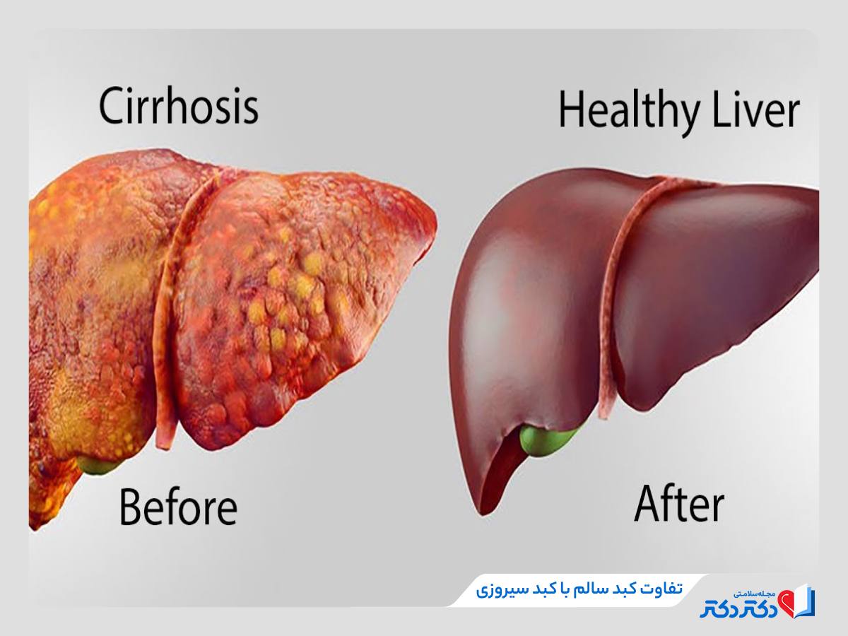 سیروز کبدی چیست و چند نوع دارد؟ + علائم و درمان_رنگو 24 مقایسه کبد سالم با کبد مبتلا به سیروز