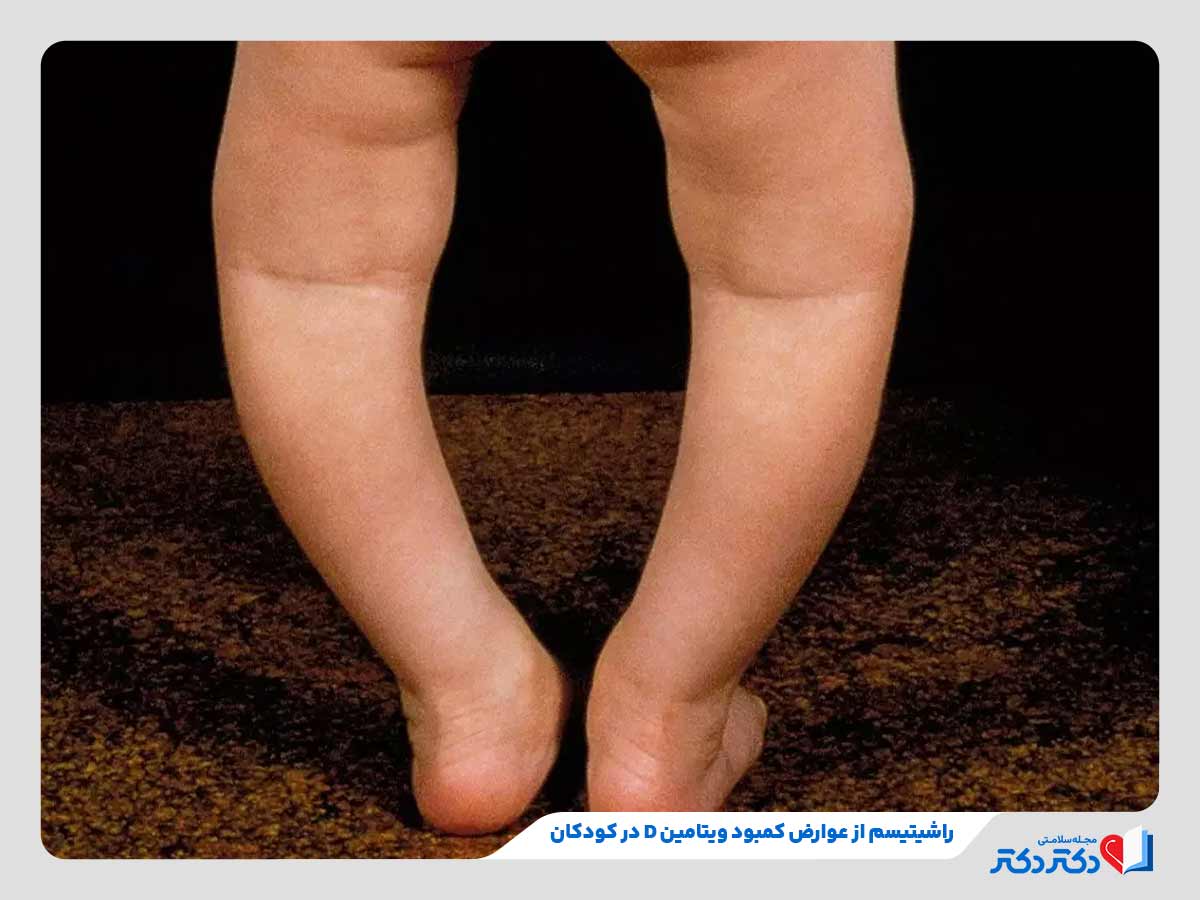 کودک مبتلا به راشیتیسم به دلیل کمبود ویتامین دی