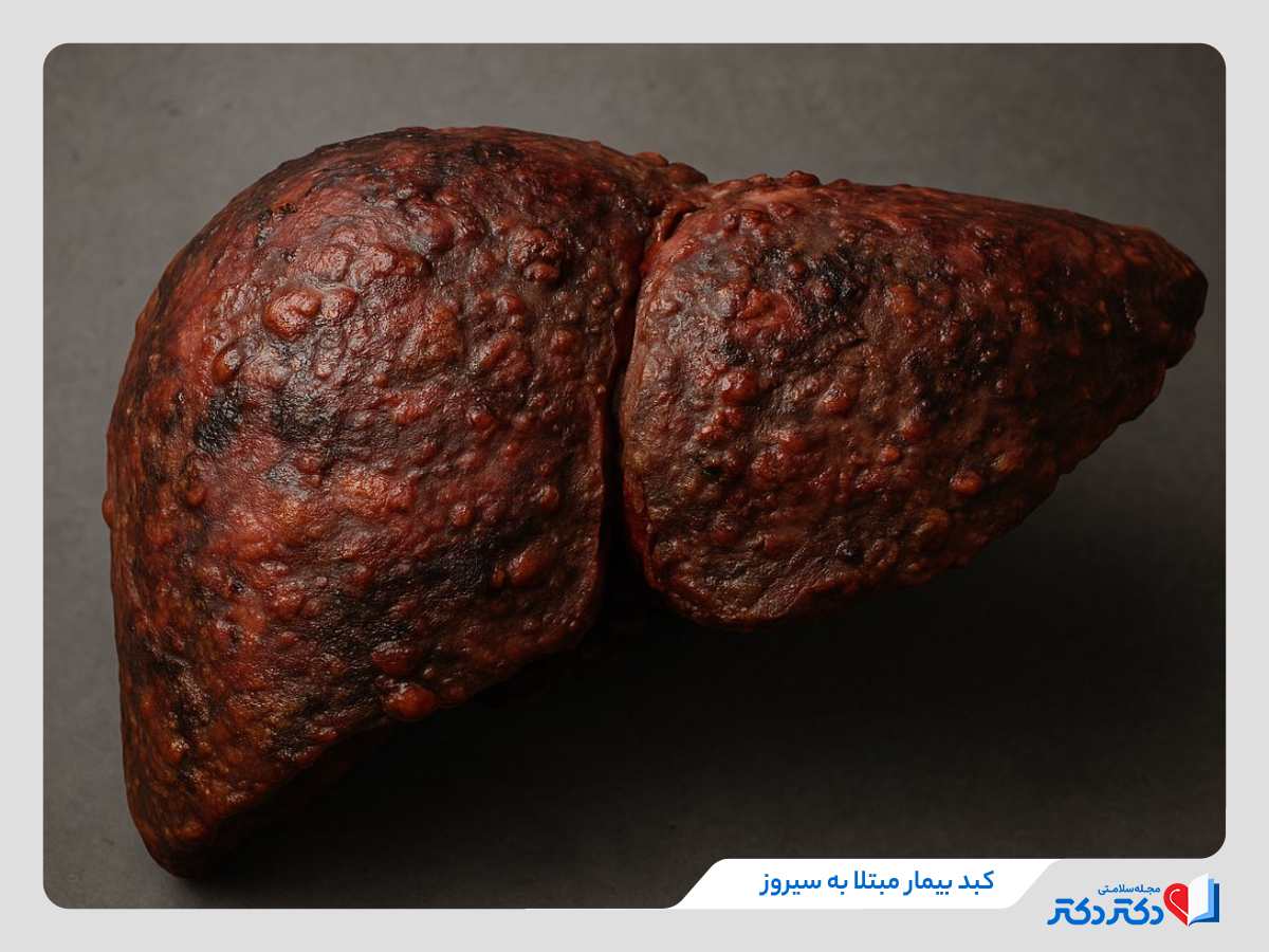 سیروز کبدی چیست و چند نوع دارد؟ + علائم و درمان_رنگو 20 کبد مبتلا به سیروز، عکس سیروز کبدی