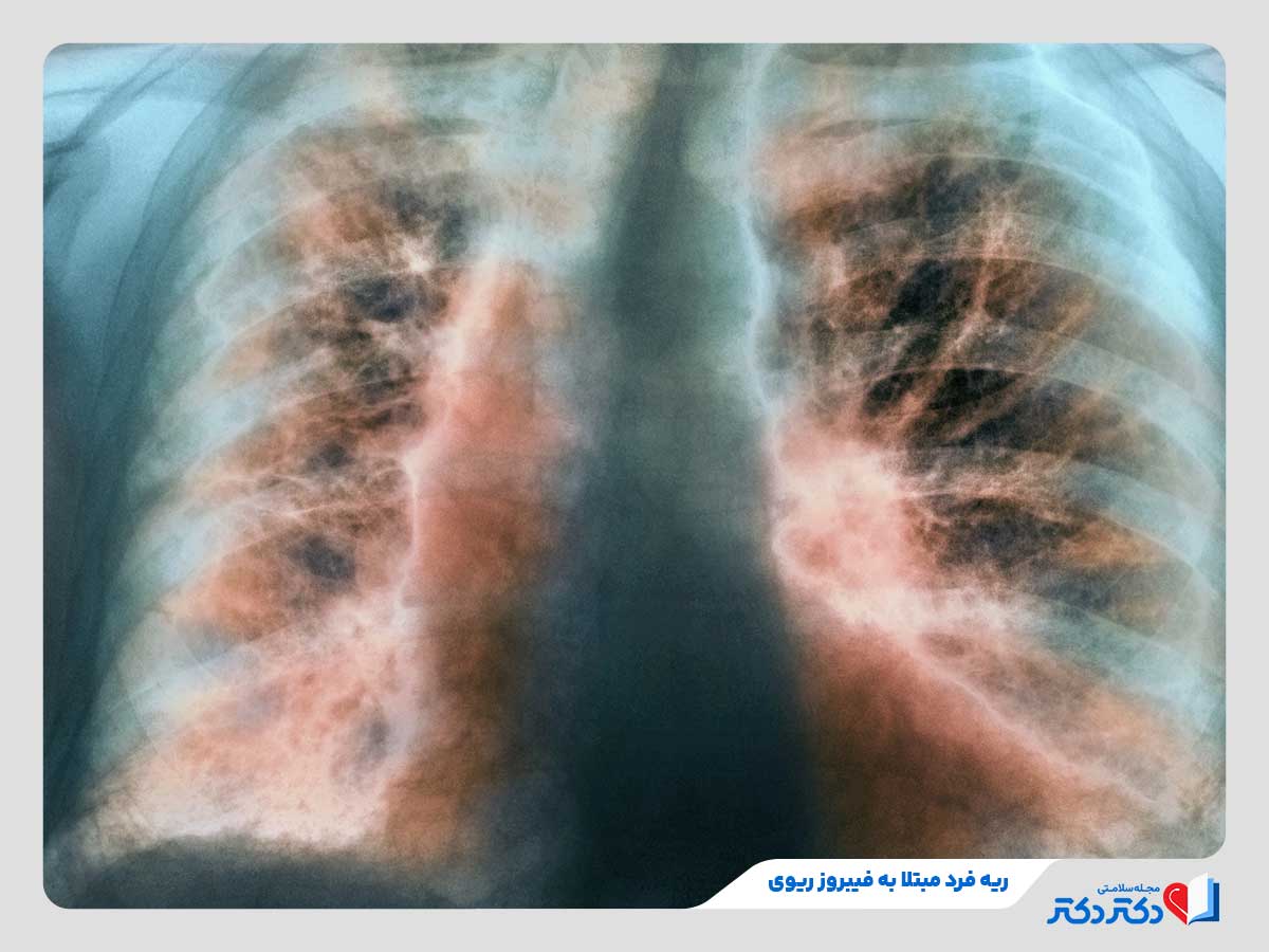 معارفه همه بیماری های ریه + راه حلهای پشگیری و درمان انواع آن_رنگو 18 فرد مبتلا به فیبروز ریوی یکی از انواع بیماری های ریه