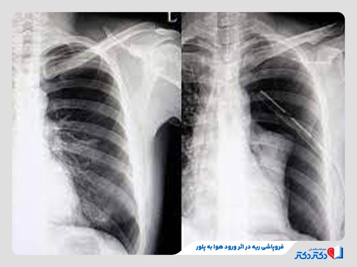 معارفه همه بیماری های ریه + راه حلهای پشگیری و درمان انواع آن_رنگو 20 ریه فرد مبتلا به پنوموتوراکس یکی از انواع بیماری ریوی