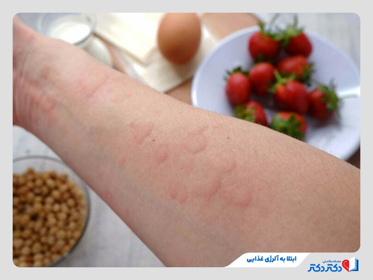 فرد مبتلا به کهیر در اثر ابتلا به حساسیت غذایی