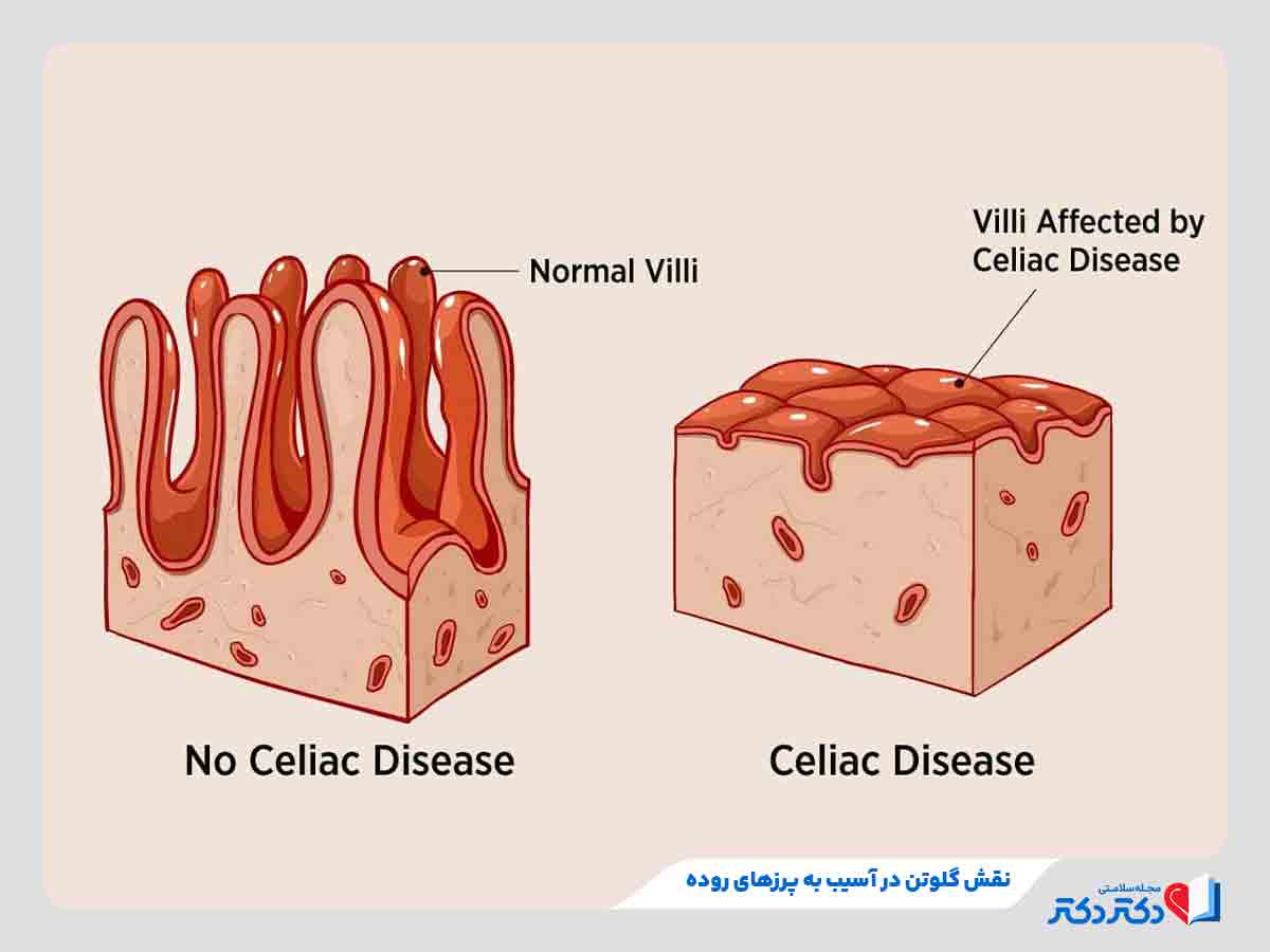 بیماری سلیاک چیست؟ بازدید علل و راههای درمان این بیماری_رنگو 2 تصویر پرزهای آسیبدیده روده فرد مبتلا به بیماری سلیاک