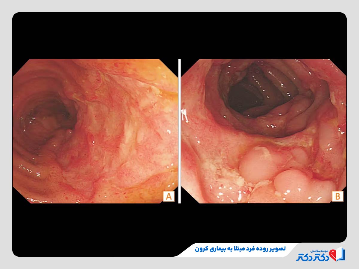 بیماری کرون چیست؟ + علائم، علل و راه حلهای درمان این بیماری_رنگو 20 تصویر روده فرد مبتلا به بیماری کرون
