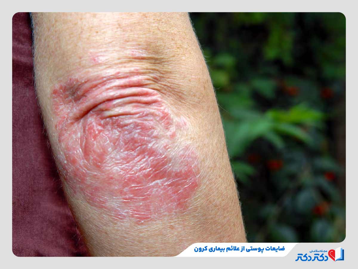 بیماری کرون چیست؟ + علائم، علل و راه حلهای درمان این بیماری_رنگو 18 زن دچار به ضایعات پوستی به دلیل ابتلا به بیماری کرون