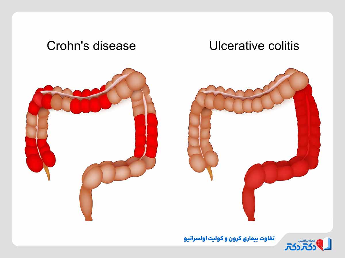 التهاب‌های قطعه‌ای و تکه‌ای ناشی از بیماری کرون