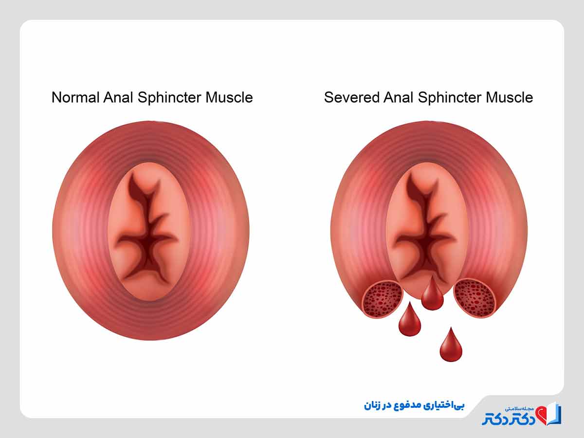 عضلات اسفنکتر آسیب دیده در زنان در زایمان طبیعی و ابتلا به بی اختیاری مدفوع