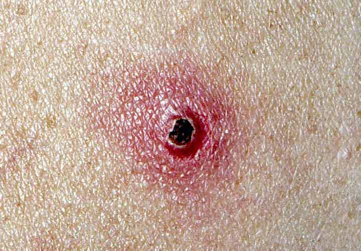 بیماری هایی که از گربه به انسان منتقل می‌شوند - بیماری خراش گربه یک بیماری مشترک بین انسان و گربه است که از طریق کنه یا چنگال گربه آلوده به انسان منتقل می شود.