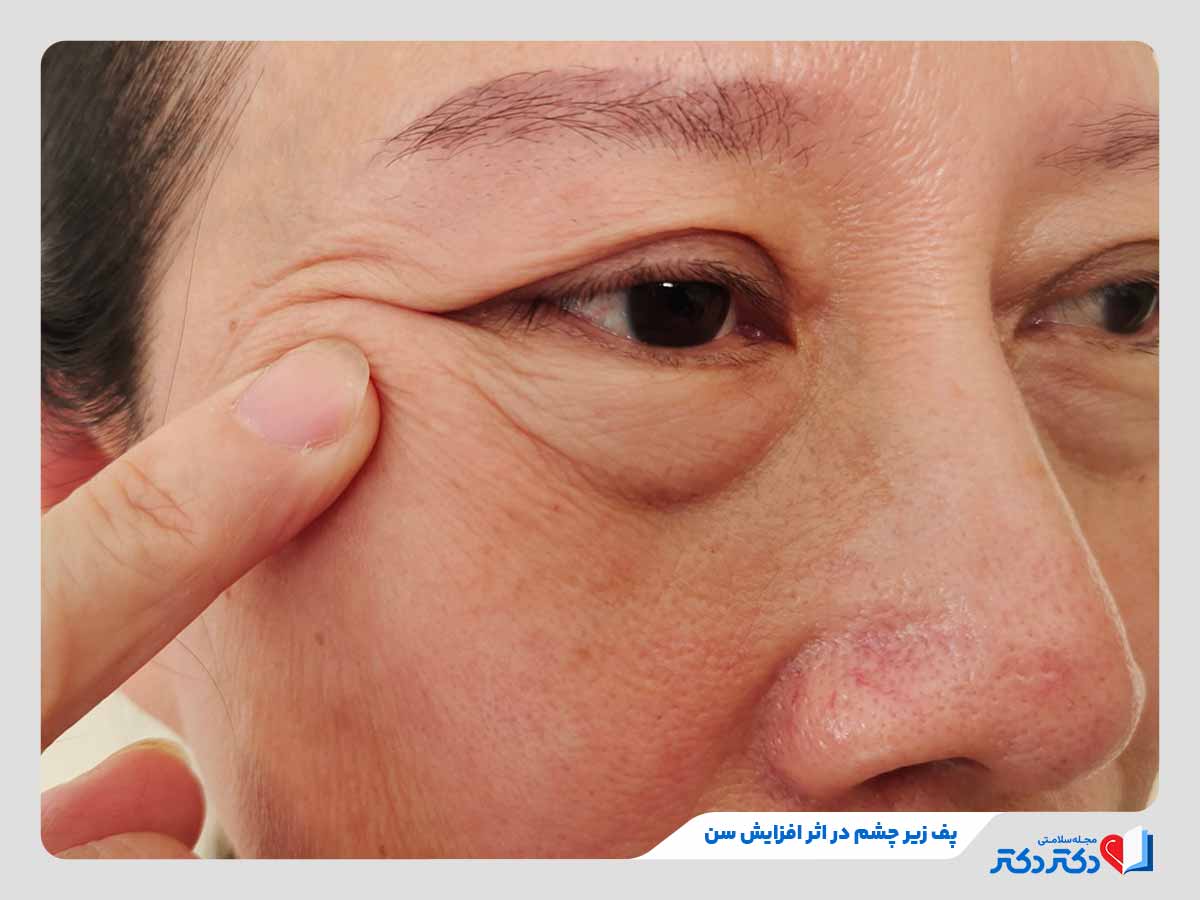 پف زیر چشم چیست؟ 12 علت پف چشم + راه حلهای سریع درمان خانگی_رنگو 2 زن مبتلا به پف زیر چشم در اثر افزایش سن